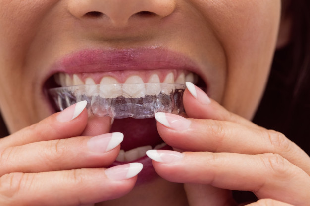 Best Invisalign Treatments in Bangalore Best Invisalign Treatments in Bangalore