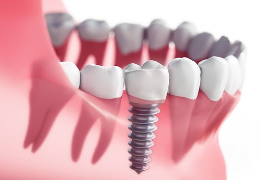 Best Dental Implant Treatment in Bangalore Best Dental Implant Treatment in Bangalore