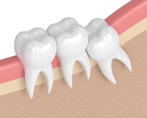 Best Wisdom Teeth Removal in Bangalore Best Wisdom Teeth Removal in Bangalore