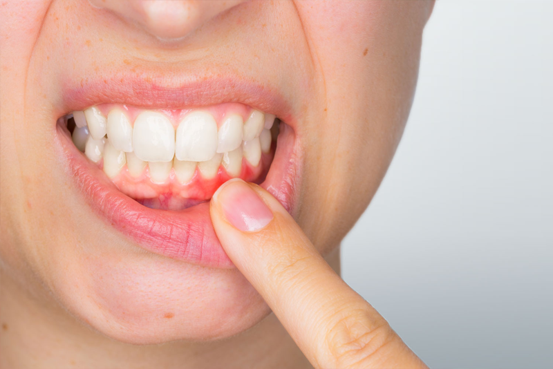 Best Gum Treatments in Bangalore Best Gum Treatments in Bangalore
